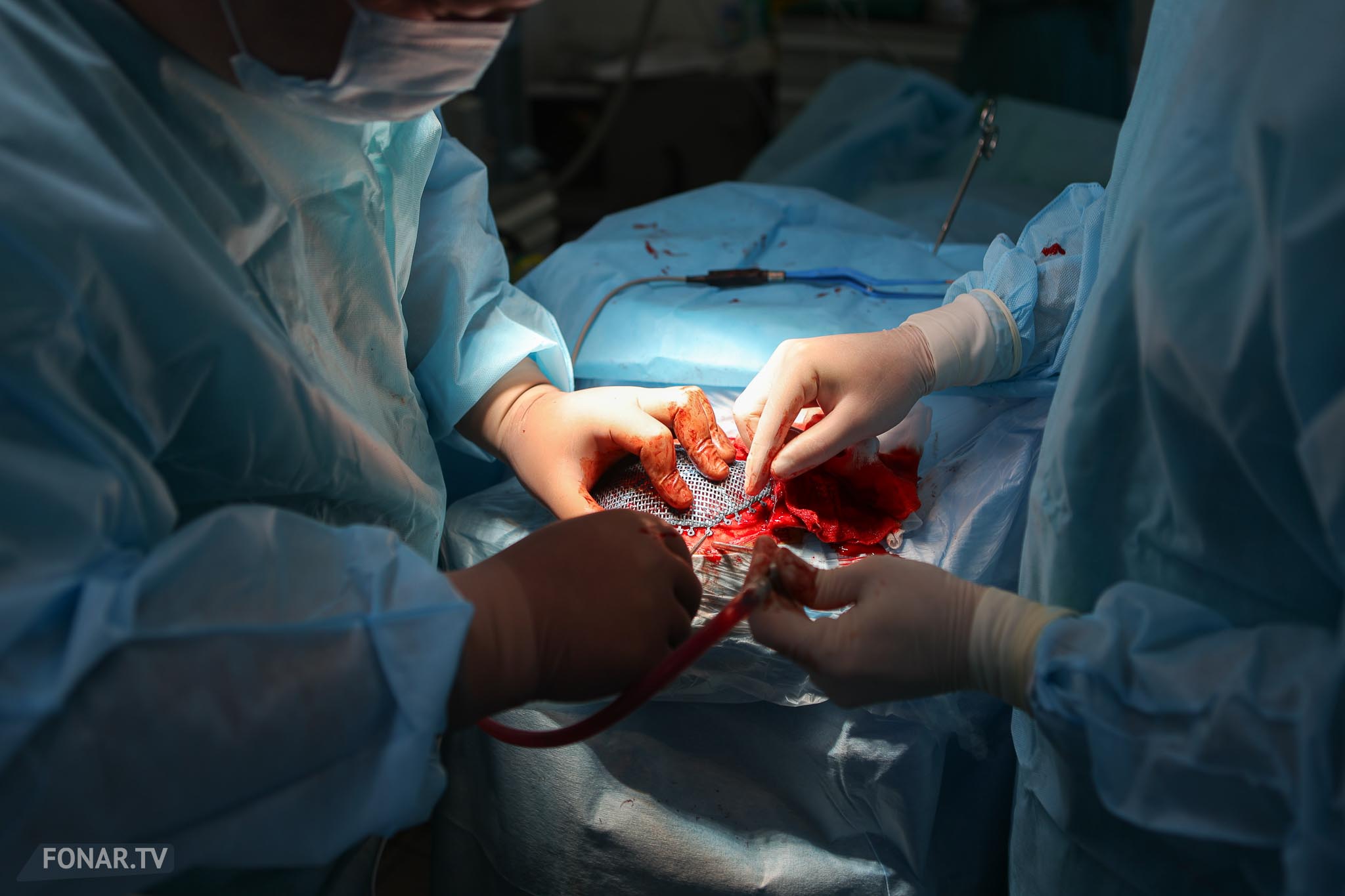 Пластическая операция  по установке 3D-печатной пластины пациенту для замещения дефекта костей свода черепа в Белгородской ОКБ Святителя Иоасафа, 11 апреля 2024 года