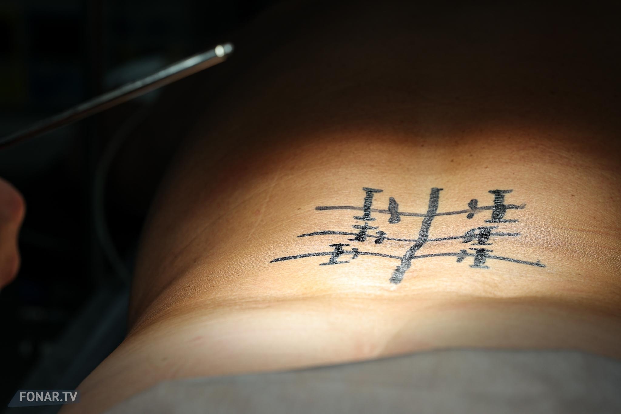 Малоинвазивная операция титановыми пластинами отечественного производства в Белгородской областной клинической больнице Святителя Иоасафа, 14 августа 2025 года